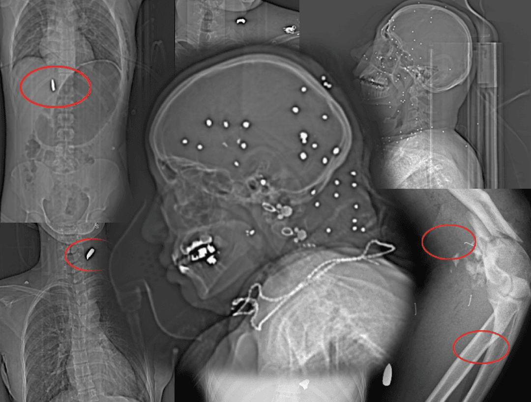 pattern street X-Ray image 1